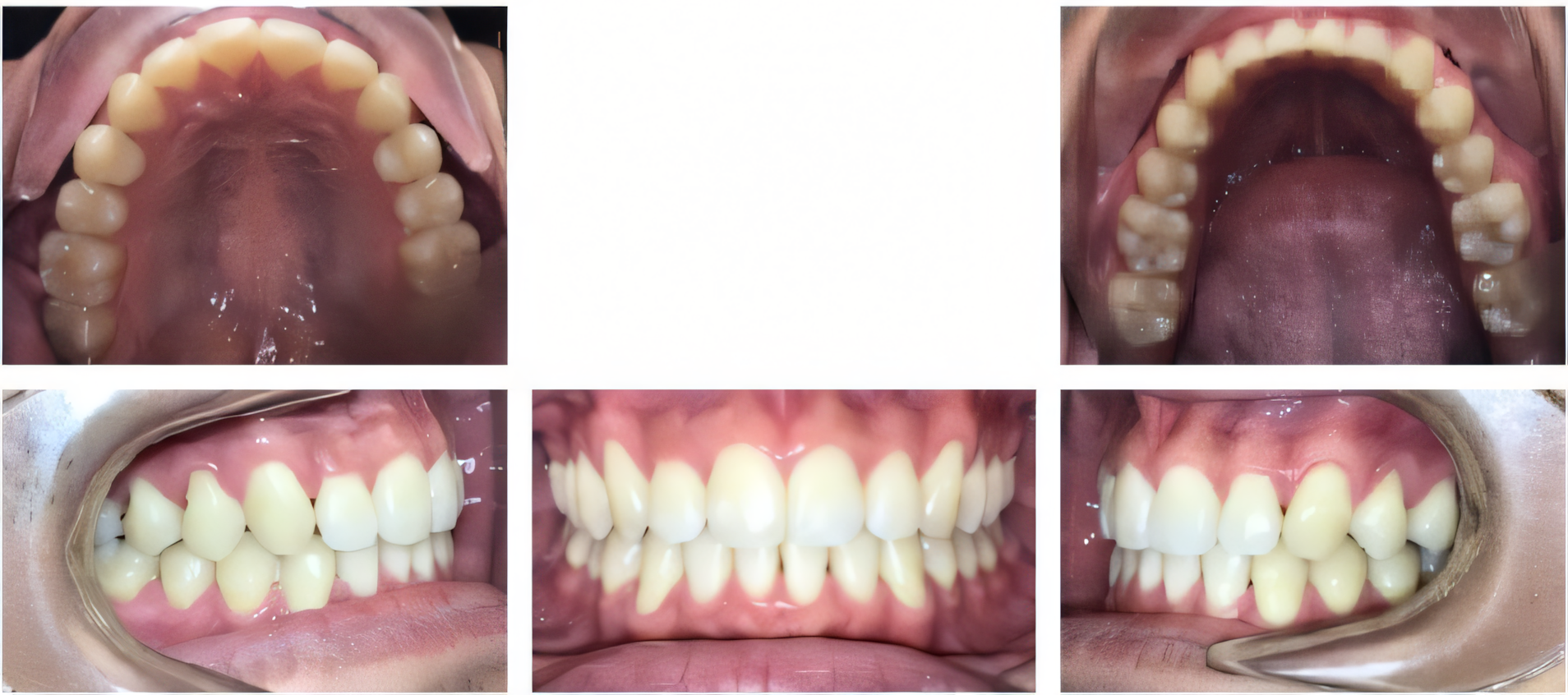Invisalign for teens after